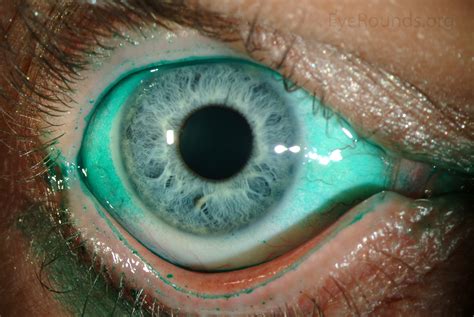 lissamine green staining dry eye